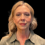 Blepharoplasty before and after - before