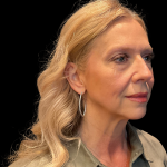 Blepharoplasty before and after - before