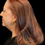 Facelift before and after - before