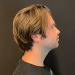 Chin before and after - before