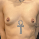 Procedure before and after - before