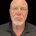 Blepharoplasty before and after - before