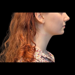 Chin before and after - before