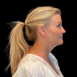 Blepharoplasty before and after - before