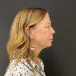 Blepharoplasty before and after - before