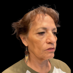 Blepharoplasty before and after - before