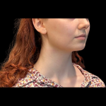 Chin before and after - before
