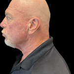 Blepharoplasty before and after - before