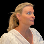 Blepharoplasty before and after - before