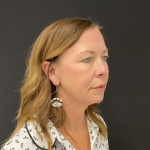 Blepharoplasty before and after - before