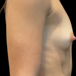 Procedure before and after - before