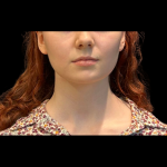 Chin before and after - before