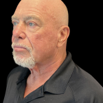 Blepharoplasty before and after - before