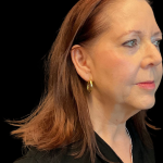 Facelift before and after - before