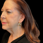 Facelift before and after - before