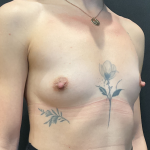 Procedure before and after - before