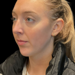 Chin before and after - before