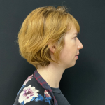 Chin before and after - before