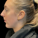 Chin before and after - before