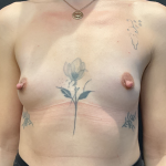 Procedure before and after - before