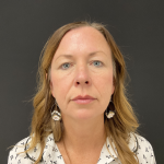 Blepharoplasty before and after - before