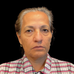 Blepharoplasty before and after - before