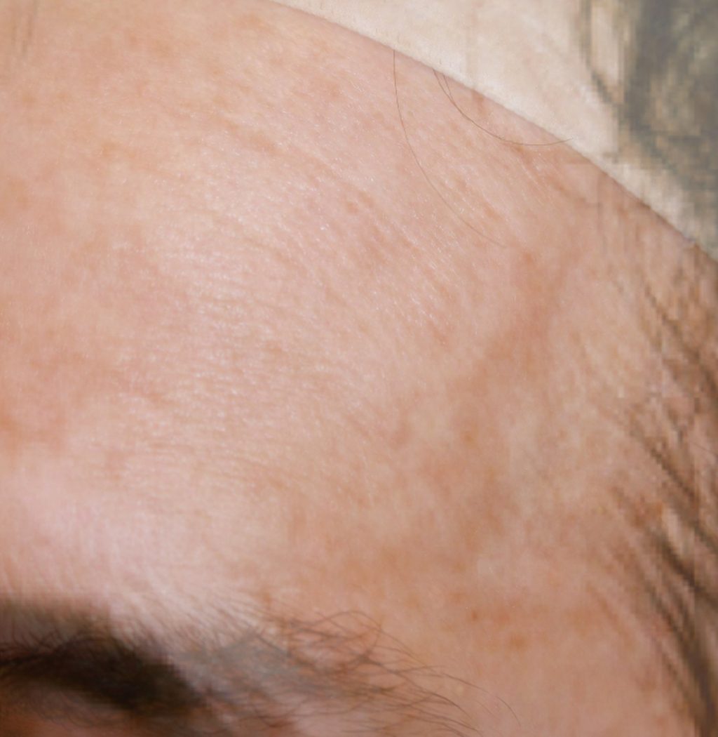 Brazilian Butt Lift by Dr. Calvin Young — after