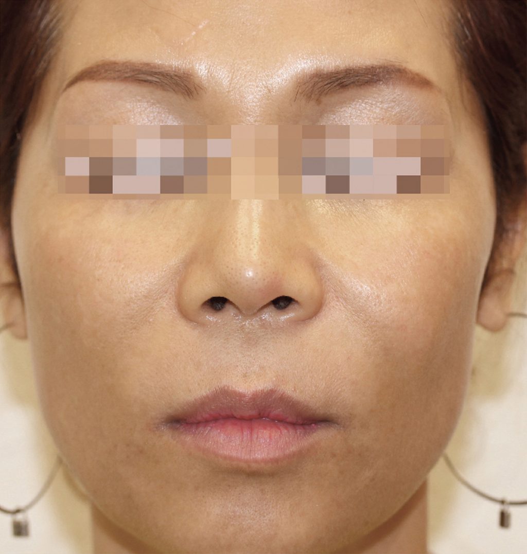 Brazilian Butt Lift by Dr. Calvin Young — after