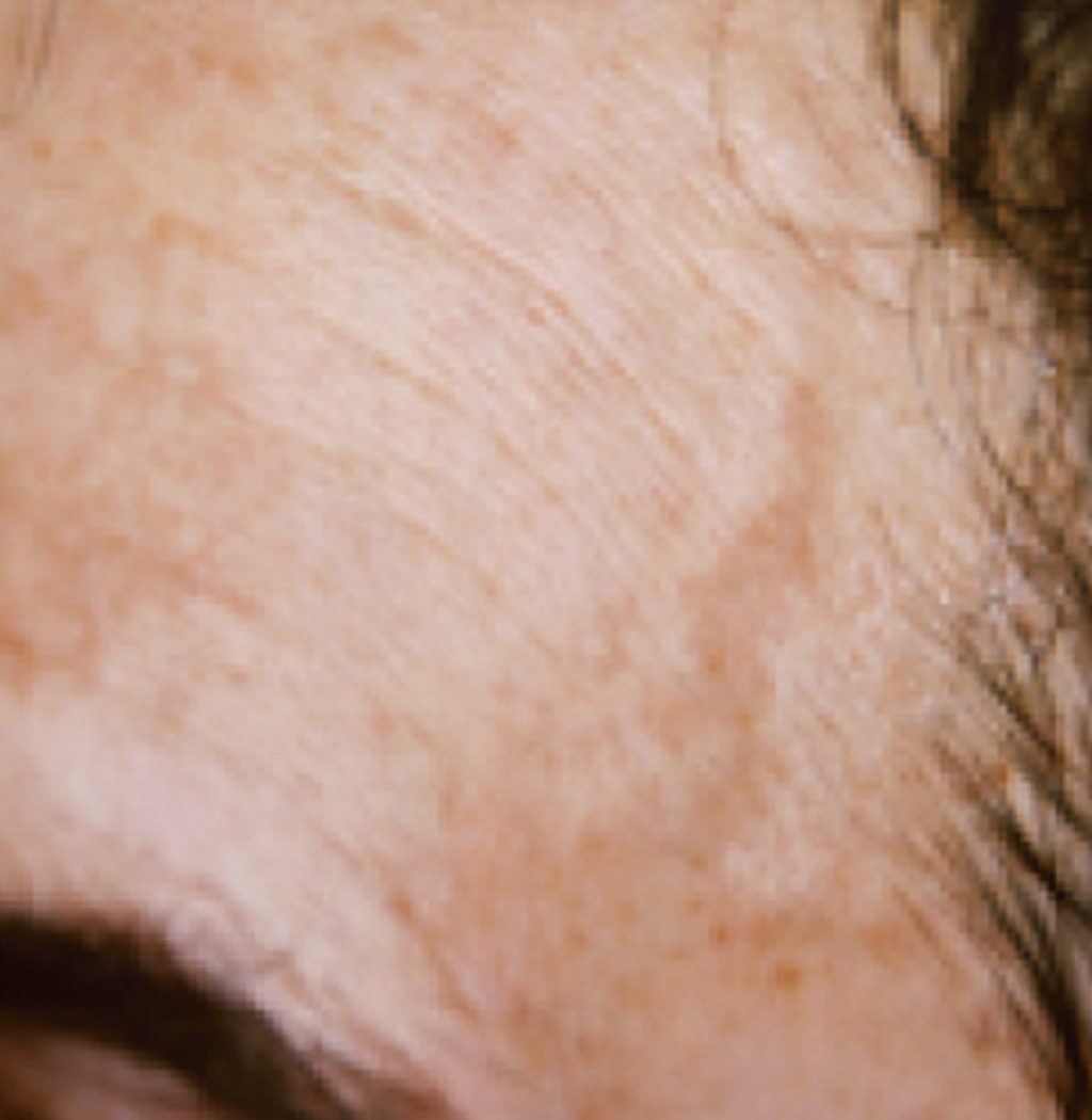 Brazilian Butt Lift by Dr. Calvin Young — before