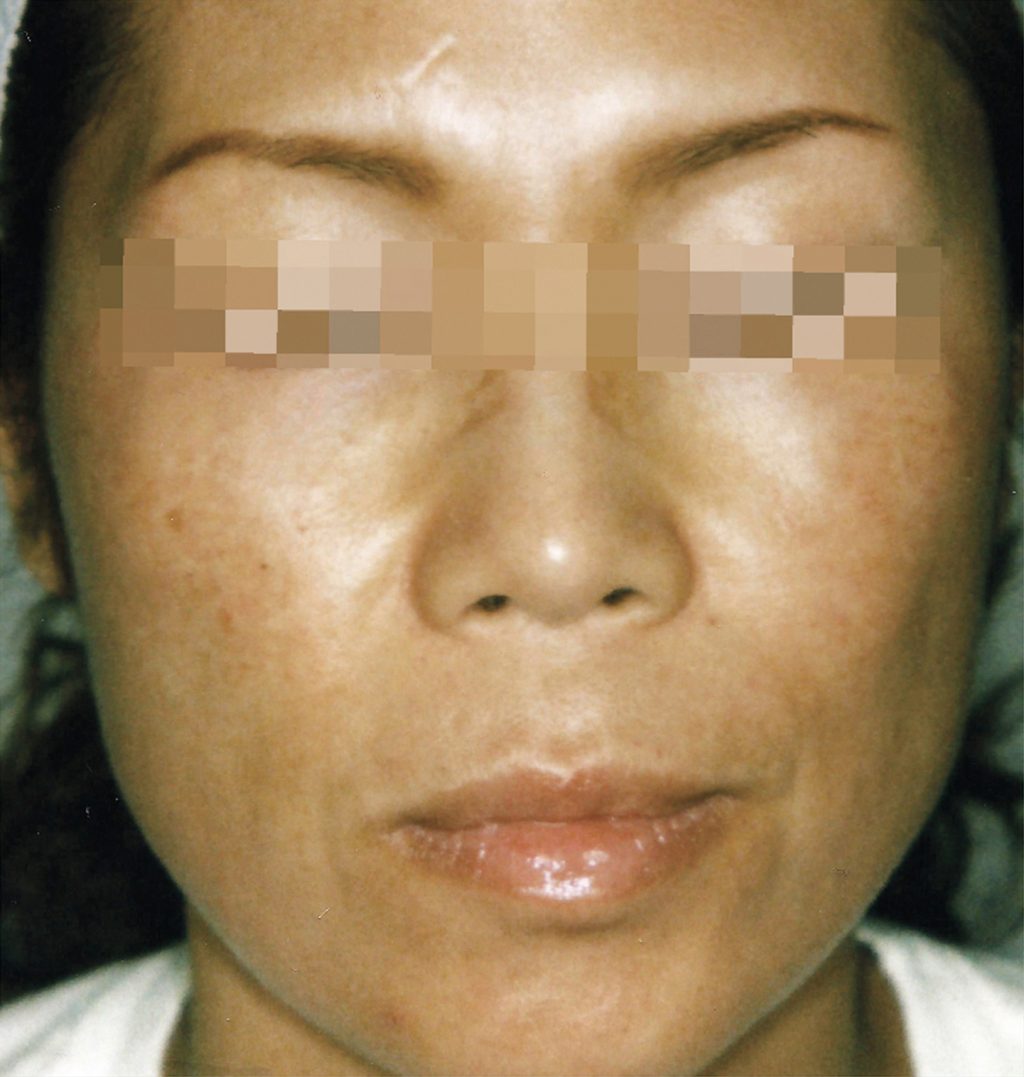 Brazilian Butt Lift by Dr. Calvin Young — before