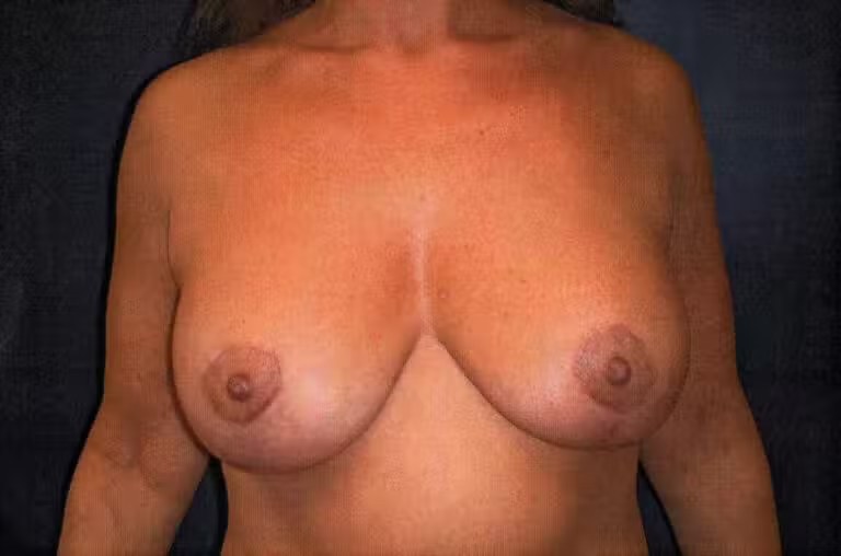 Breast Augmentation before and after - after