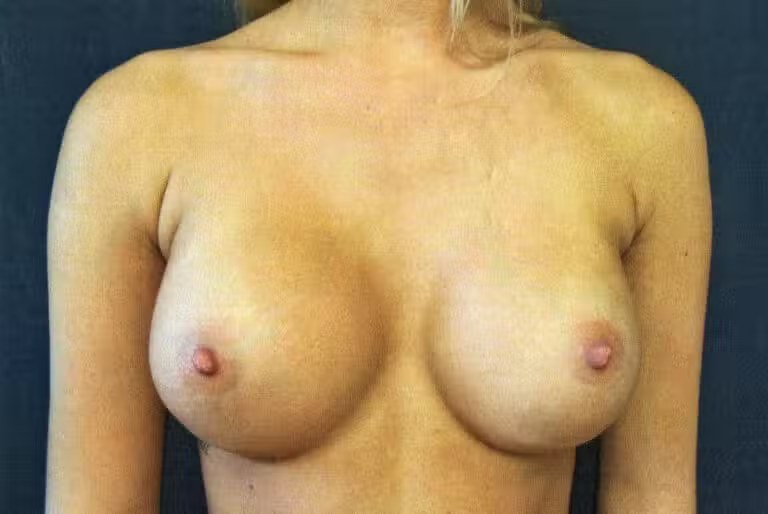 Breast Augmentation before and after - after
