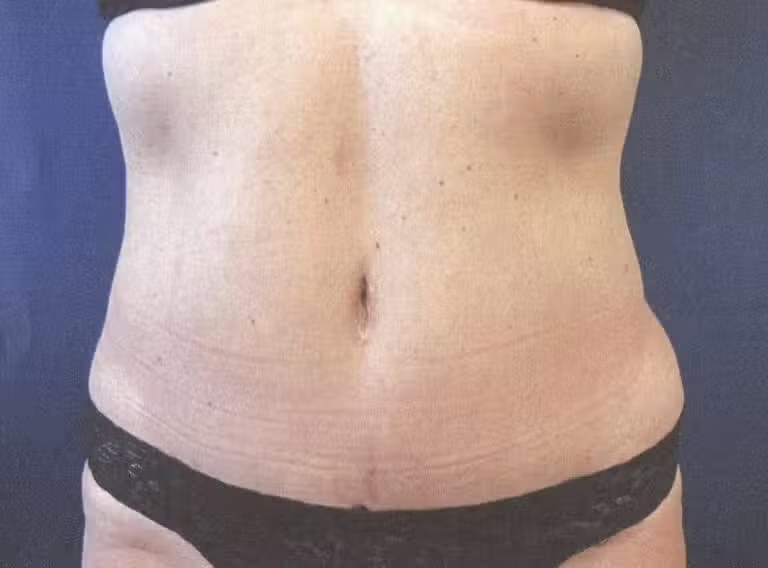Procedure before and after - after