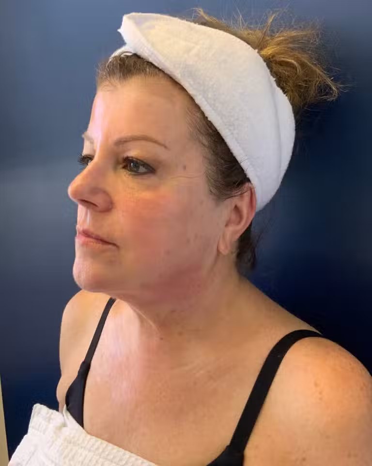Procedure before and after - after