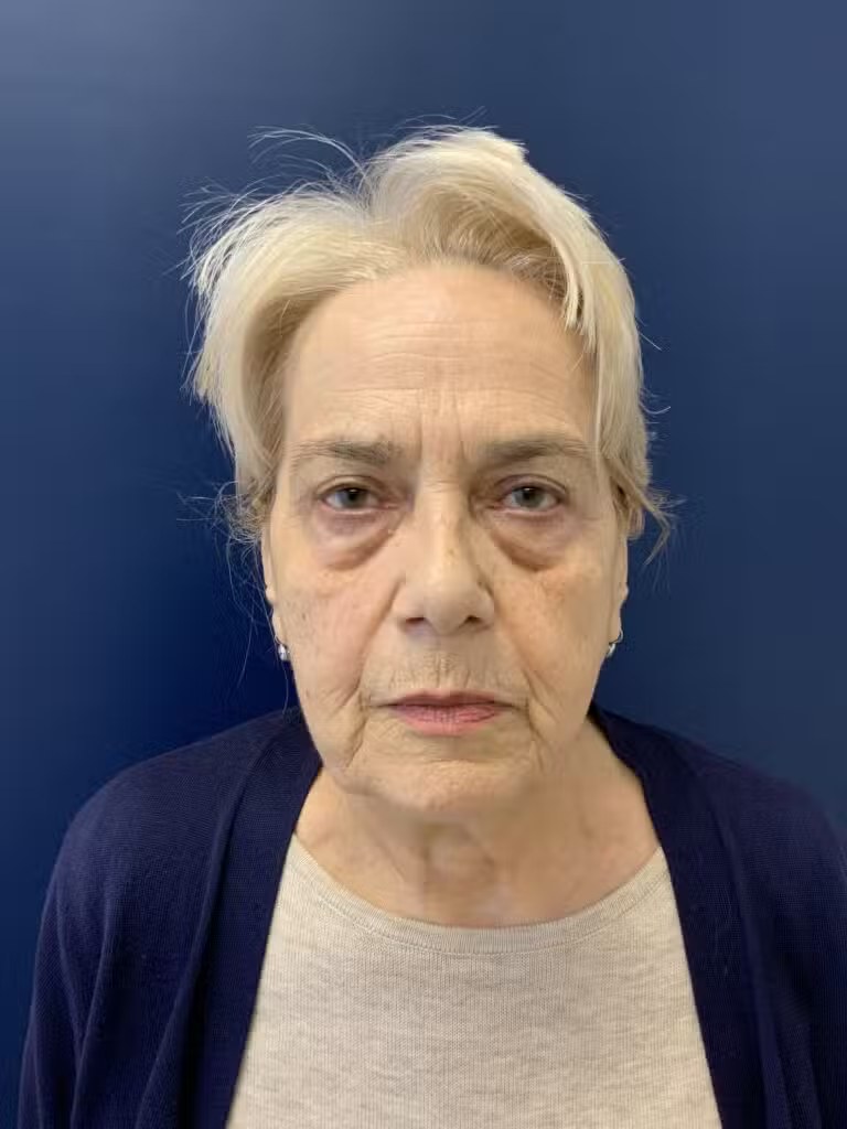 Blepharoplasty before and after - after
