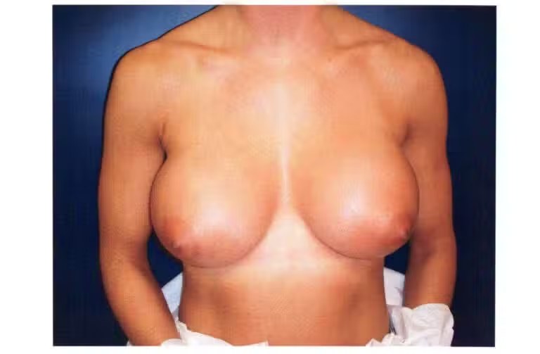 Breast Augmentation before and after - after