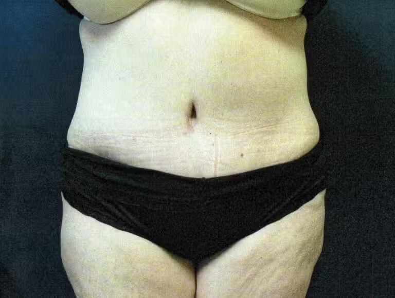 Procedure before and after - after