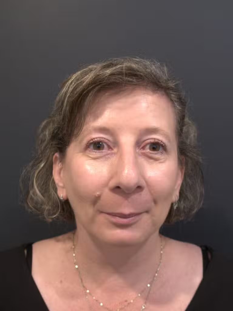 Blepharoplasty before and after - after