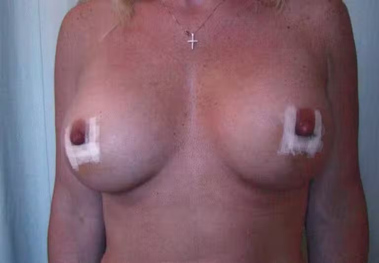 Breast Augmentation before and after - after