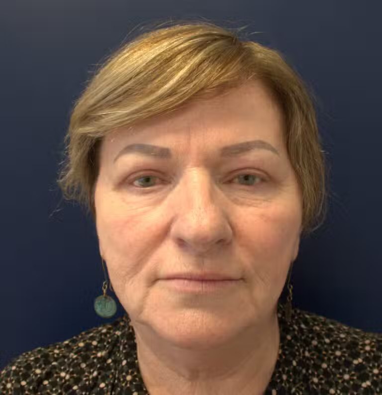 Blepharoplasty before and after - after