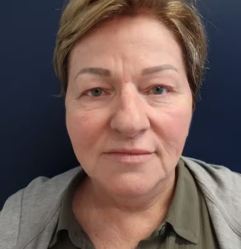 Blepharoplasty before and after - before