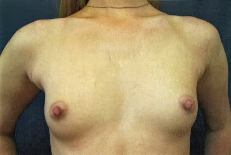 Breast Augmentation before and after - before