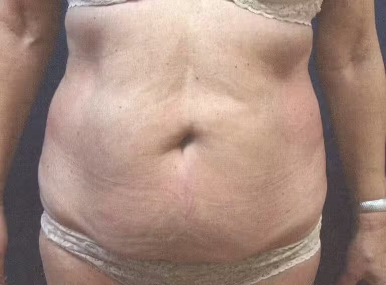 Procedure before and after - before