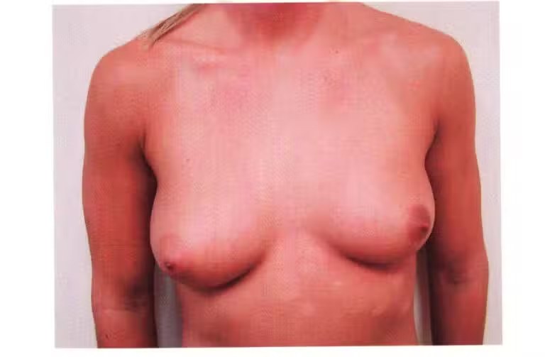 Breast Augmentation before and after - before