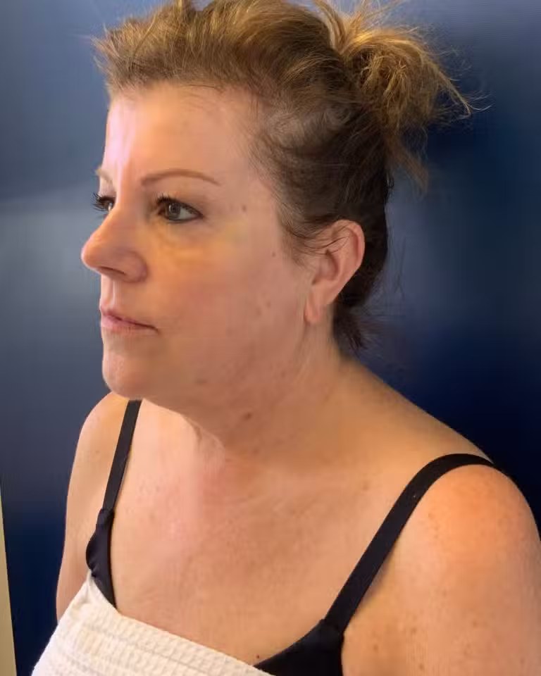 Procedure before and after - before