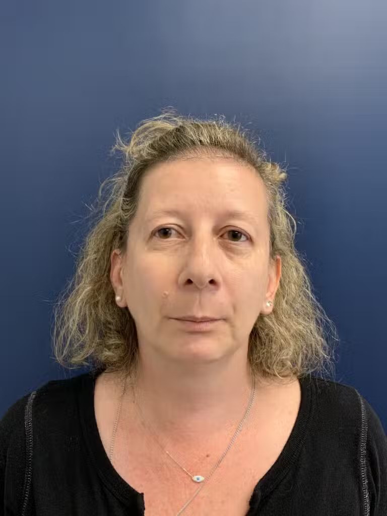 Blepharoplasty before and after - before
