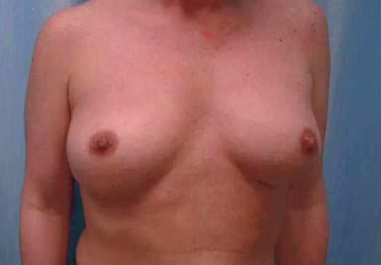 Breast Augmentation before and after - before