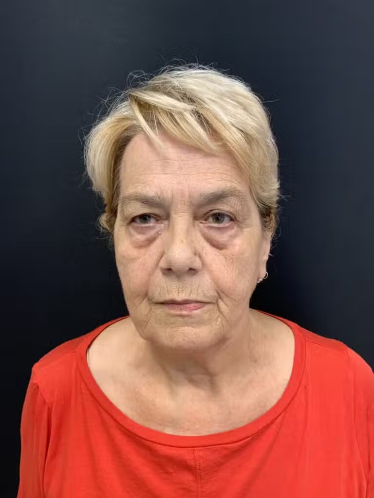 Blepharoplasty before and after - before