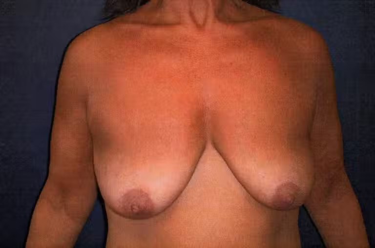 Breast Augmentation before and after - before