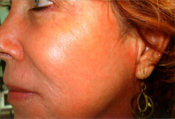 Procedure before and after - after